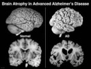 10 Facts about Alzheimer’s disease