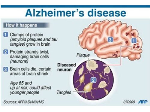 Alzheimer's Disease Facts