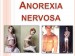8 Facts about Anorexia Nervosa