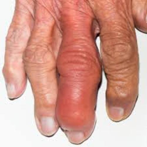 Arthritis Facts