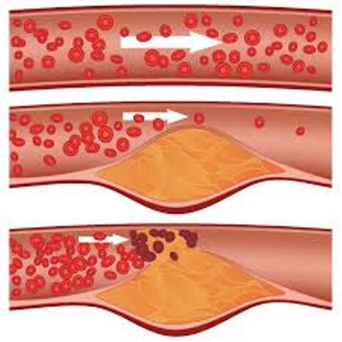 Atherosclerosis Facts