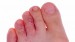 8 Facts about Athlete’s Foot