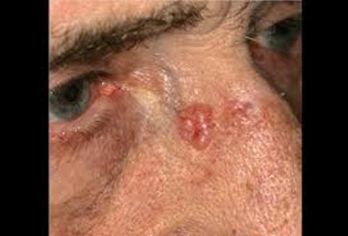 Basal Cell Carcinoma Facts