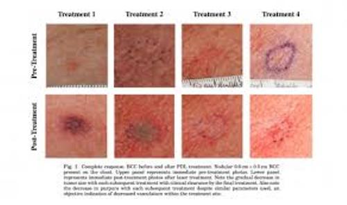Basal Cell Carcinoma Early Stages Nose Mohs Surgery Case