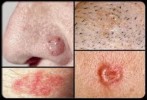 8 Facts about Basal Cell Carcinoma