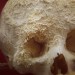 10 Facts about Bone Cancer