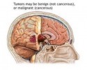 10 Facts about Brain Tumors