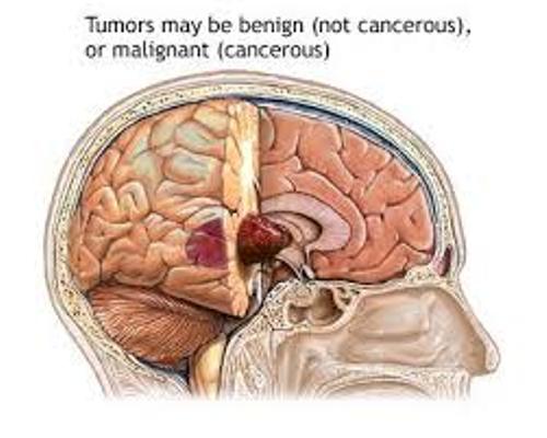 Brain Tumor Types