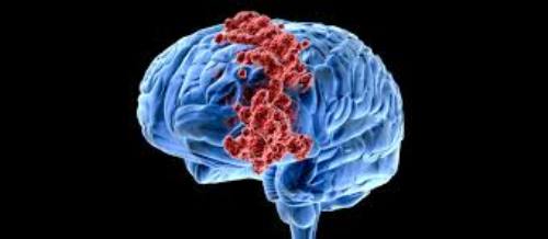 Facts about Brain Cancer