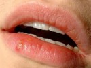 10 Facts about Cold Sores