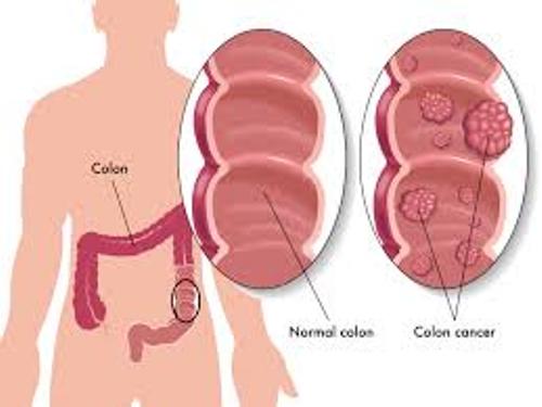 Colon Cancer Picture