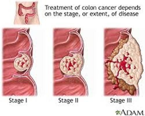 Colon Cancer facts