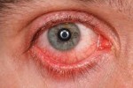 10 Facts about Conjunctivitis