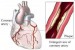 10 Facts about Coronary Heart Disease