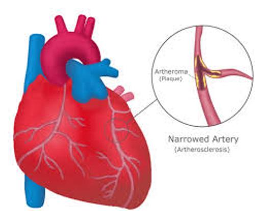 Facts about Coronary Heart Disease