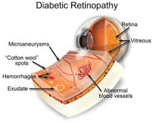 Facts about Diabetic Retinopathy