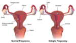 10 Facts about Ectopic Pregnancy