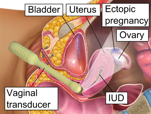 Ectopic Pregnancy Pic