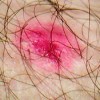 10 Facts about Eczema