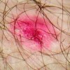 10 Facts about Eczema