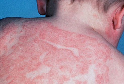 Eczema Skin